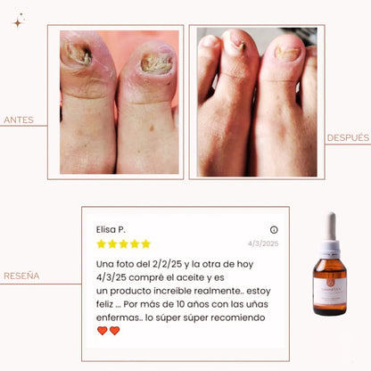 Nuevo Aceite Antihongos para PIES - Resultados Rápidos!